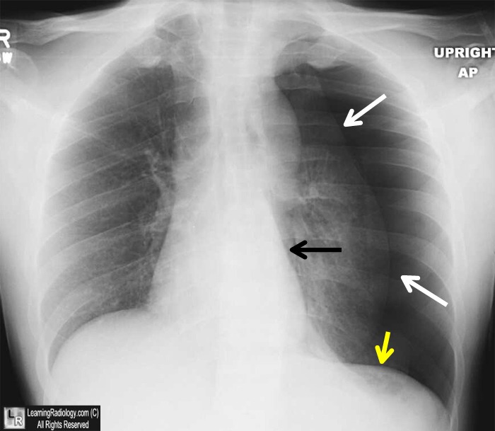 Tension Pneumothorax